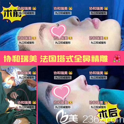 九江星瑞美隆鼻對比圖