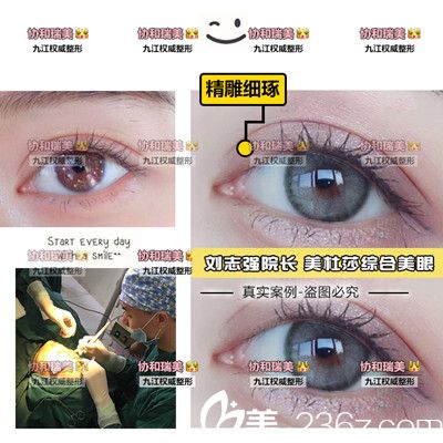 劉志強(qiáng)院長雙眼皮手術(shù)案例