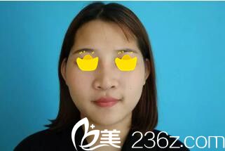 做自體脂肪填充額頭術(shù)前照 做自體脂肪填充額頭術(shù)前照