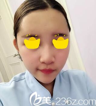 做自體脂肪填充術(shù)后第2天 做自體脂肪填充術(shù)后第2天