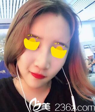 做自體脂肪填充面部術(shù)后第9天效果 做自體脂肪填充面部術(shù)后第9天效果