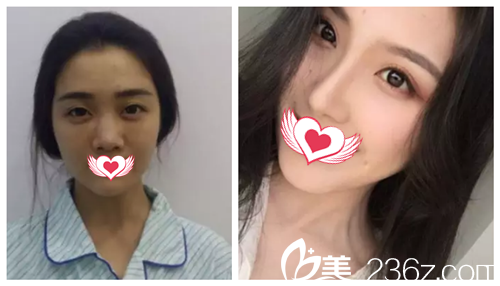 唐山蘇亞美聯(lián)臣隆鼻案例 唐山蘇亞美聯(lián)臣隆鼻案例