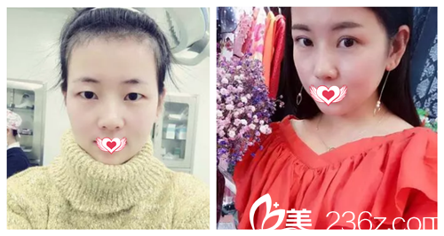 蘇亞美聯(lián)臣整形醫(yī)院雙眼皮案例 蘇亞美聯(lián)臣整形醫(yī)院雙眼皮案例