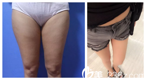 唐山蘇亞美聯(lián)臣吸脂案例 唐山蘇亞美聯(lián)臣吸脂案例