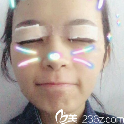 珠海艾瑞整形醫(yī)院祝小偉雙眼皮即刻效果