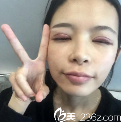 切開雙眼皮手術第三天