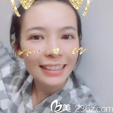 珠海艾瑞整形美容醫(yī)院祝小偉做的雙眼皮案例圖