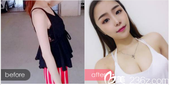 廣州曙光整形醫(yī)院郭建院長做的假體隆胸案例 廣州曙光整形醫(yī)院郭建院長做的假體隆胸案例