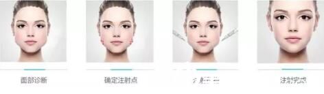 注射瘦臉理想中的效果