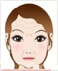 臉大的原因之四下垂型臉大