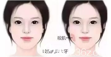 肌肉型臉大紅色標注的是臉部咬肌