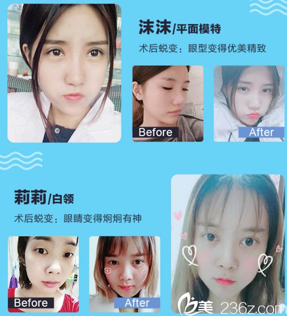 寧波博悅金式倫割雙眼皮案例 寧波博悅金式倫割雙眼皮案例