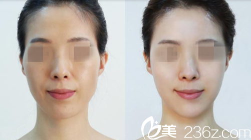 伊婉玻尿酸前后效果對(duì)比