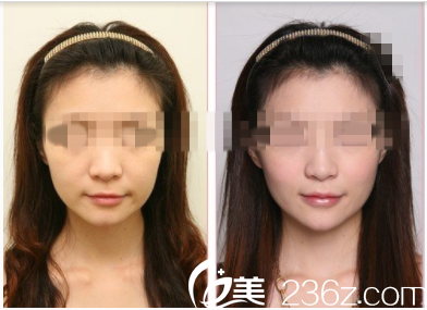 艾莉薇注射前后效果