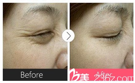 江蘇施爾美去除魚尾紋案例