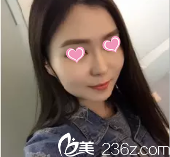 在北京米蘭柏羽麗都注射瘦臉前樣子 在北京米蘭柏羽麗都注射瘦臉前樣子