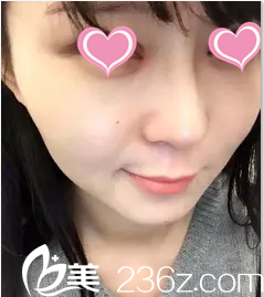 在北京米蘭柏羽麗都注射瘦臉第3天效果 在北京米蘭柏羽麗都注射瘦臉第3天效果