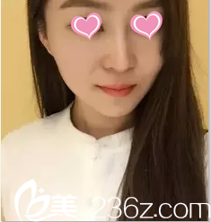 在北京米蘭柏羽麗都注射瘦臉第11天效果 在北京米蘭柏羽麗都注射瘦臉第11天效果