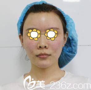 做自體脂肪填充面部當(dāng)天效果