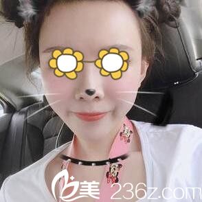 做面部自體脂肪填充面部半個月效果