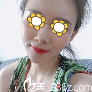 看我在長沙希美整形醫(yī)院做的自體脂肪填充面部一個月后恢復效果怎么樣？