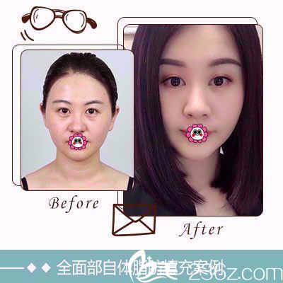 雅芳亞面部填充案例 雅芳亞面部填充案例