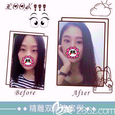 石家莊雅芳亞9月整形優(yōu)惠價格表公開 雙眼皮和半紋眉都只要880元