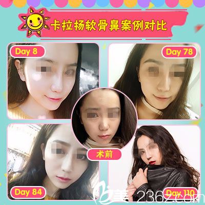 石家莊雅芳亞隆鼻案例 石家莊雅芳亞隆鼻案例