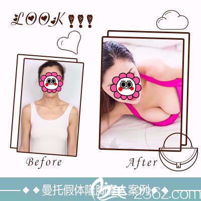 雅芳亞曼托假體隆胸案例 雅芳亞曼托假體隆胸案例