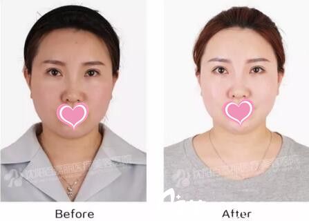 沈陽百嘉麗真人注射前后效果對比