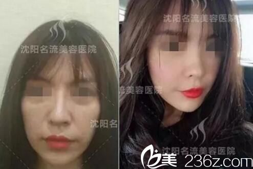 沈陽(yáng)名流董紅星醫(yī)生自體脂肪填充面部真人前后效果展示