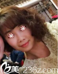 重慶美侖美奐肖倩玻尿酸去法令紋效果 重慶美侖美奐肖倩玻尿酸去法令紋效果