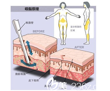 銘源皇宮吸脂瘦身原理
