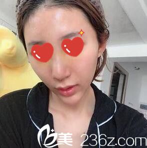 做假體綜合隆鼻術(shù)后一周拆線