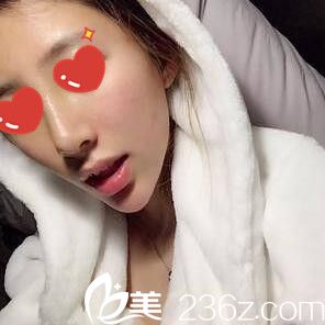 在<!--<i data=20240703-sp></i>-->做假體綜合隆鼻術(shù)后半個(gè)月<span style=