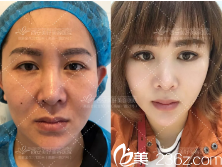 西安美好醫(yī)院面部提升的案例