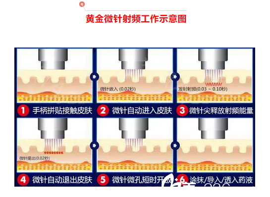 黃金微針射頻工作原理示意圖
