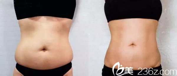 腰腹部抽脂需要多少錢？腰腹部吸脂案例