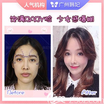 廣州韓妃于洪瑞做的自體脂肪全臉填充案例 廣州韓妃于洪瑞做的自體脂肪全臉填充案例