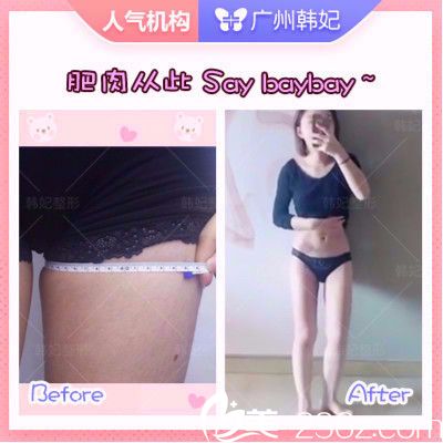 廣州韓妃于洪瑞做的大腿吸脂案例圖 廣州韓妃于洪瑞做的大腿吸脂案例圖