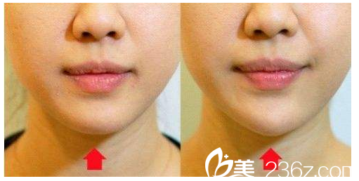 注射玻尿酸豐下巴