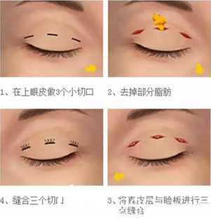 做韓式三點雙眼皮的手術(shù)過程