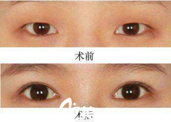 韓式三點雙眼皮術(shù)前術(shù)后對比效果
