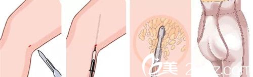 大腿吸脂術(shù)后護(hù)理注意事項(xiàng)