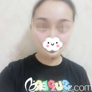 面部吸脂術(shù)后天 面部吸脂術(shù)后天