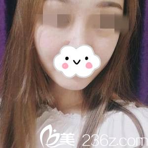 我在湖南做面部吸脂，術(shù)后不到一個(gè)月驚喜的擁有了V字臉