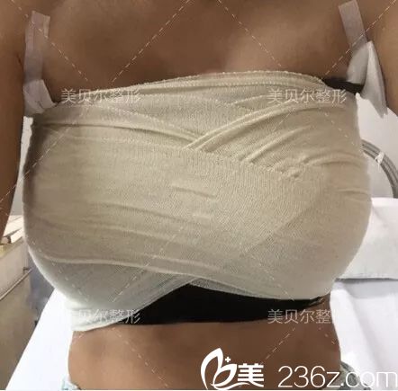 剛做完娜綺麗假體隆胸術(shù)后恢復(fù) 剛做完娜綺麗假體隆胸術(shù)后恢復(fù)