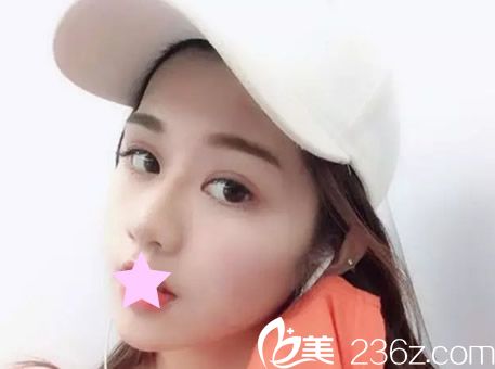 蘭州明倫整形正規(guī)嗎 于晟醫(yī)生鼻綜合隆鼻的技術(shù)和效果果然名不虛傳