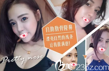 自體軟骨隆鼻案例