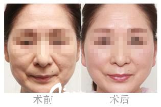除皺前后效果